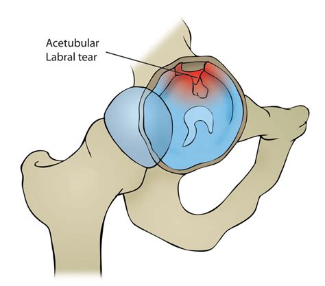 acetabular labral tear tests|right superior acetabular labral tear.